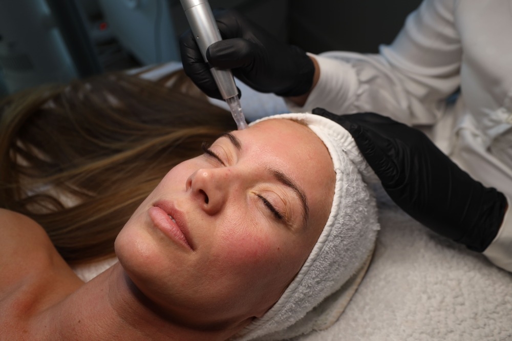 dermapen microneedling tretman